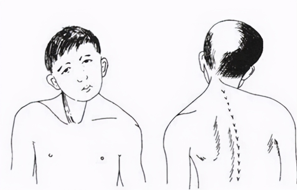 咀嚼导致的大小脸怎么恢复,单侧咀嚼大小脸可以恢复吗