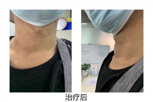 甲状腺消融术治疗甲状腺结节,甲状腺结节微创消融术器材