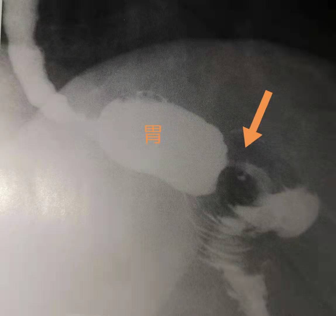 辟谣：每餐少吃点，胃就会缩小？医生说：缩胃手术减肥要谨慎