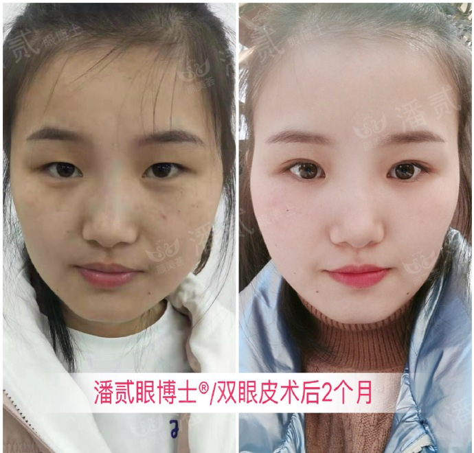 双眼皮离眉毛太近还能修复好吗,割双眼皮眉毛下面肿会消肿吗