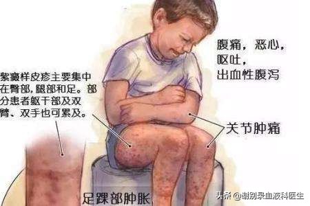 过敏性紫癜潜在并发症护理计划,过敏性紫癜会引起什么并发症