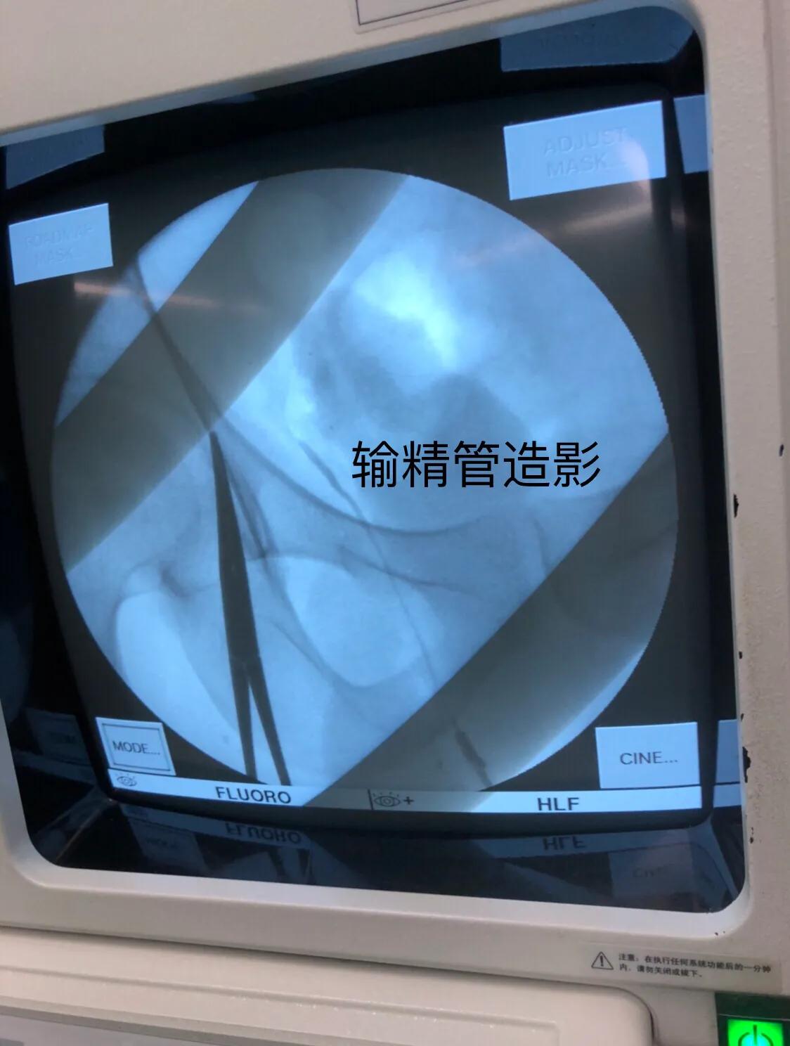 男性输精管梗阻微创手术成功率,男科显微手术有哪些