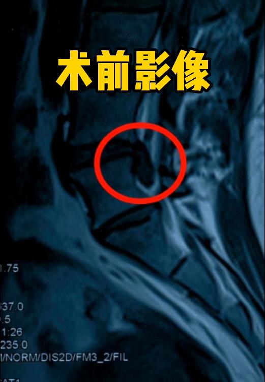 宝妈腰间盘突出是什么引起的,宝妈生过宝宝后腰疼怎么办