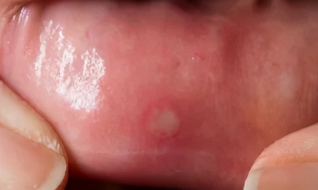 为什么会有季节性口腔溃疡,桥本会引发口腔溃疡吗