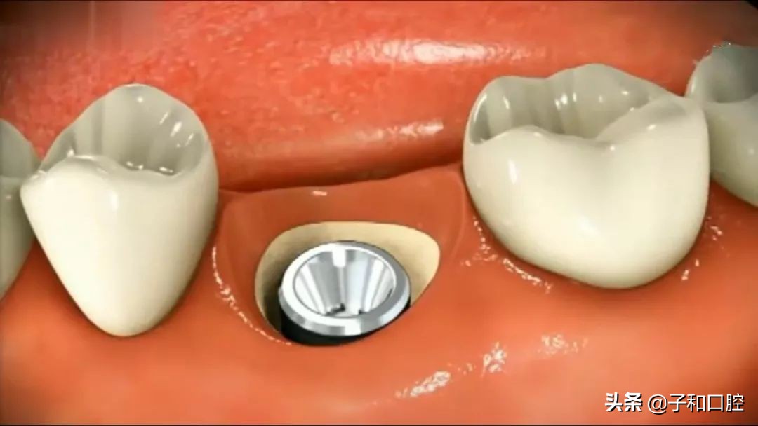 30秒看懂种植牙的全过程北大口腔,30秒看懂种植牙的全过程