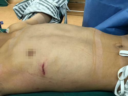 少年漏斗胸怎么矫正,宝贝漏斗胸怎么治疗比较好