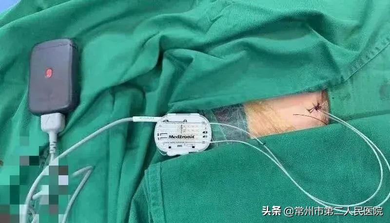 常州市二院疼痛科,常州二院疼痛科