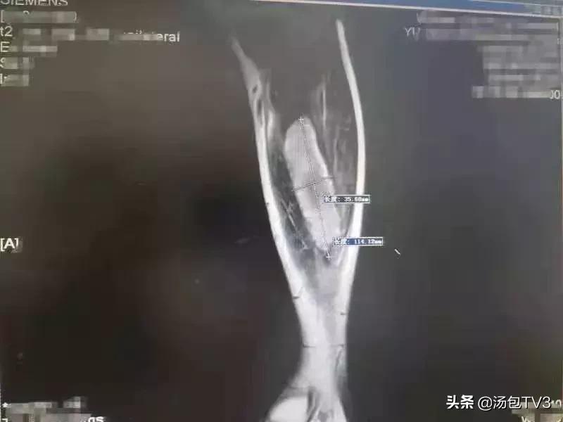 爹爹爬楼梯爬成网球腿医生：平时动运少了