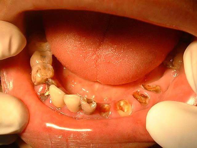 补牙根管治疗一般治疗几次,为什么补牙一定要做根管治疗