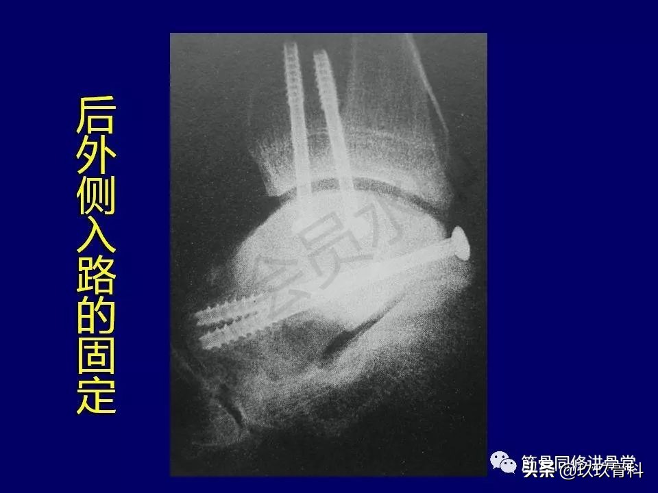 距骨骨折的治疗原则,距骨骨折如何调理