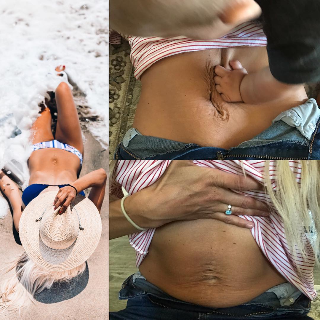 如何避免出现妊娠纹这5步要做好,怎么预防妊娠纹的发生