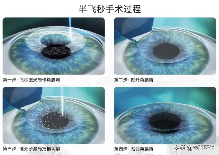 医生戴着眼镜讲近视手术的好处,没戴过眼镜适合做近视手术吗