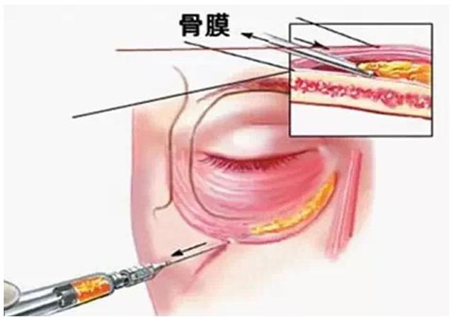 如何让泪沟消失小技巧,泪沟真的毫无办法吗