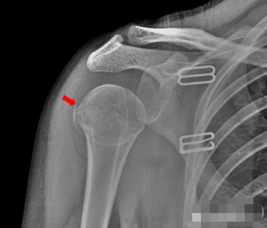 怎样发现骨折的可能性,一招看出手指骨折