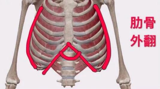 肋骨外翻生活体态怎么调整,体态矫正可以治疗肋骨外翻吗