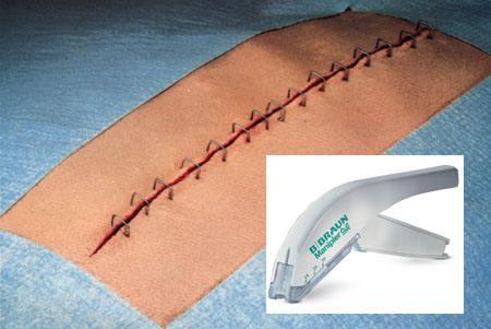 外伤缝合人工好还是订书机缝合好,骨科手术为什么用缝合钉