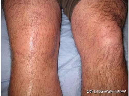 骨折膝关节粘连到哪里康复好,骨折后膝关节粘连怎么锻炼