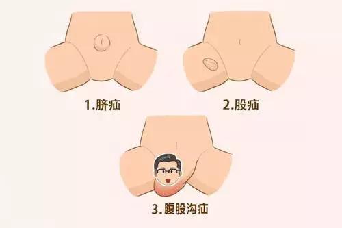 宝宝得脐疝一般多久能好,成人脐疝4-5公分用做手术吗