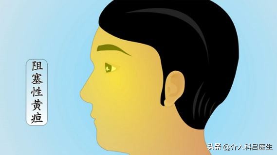 黄疸肝炎最佳治疗方法微创,黄疸最佳治疗方法微创