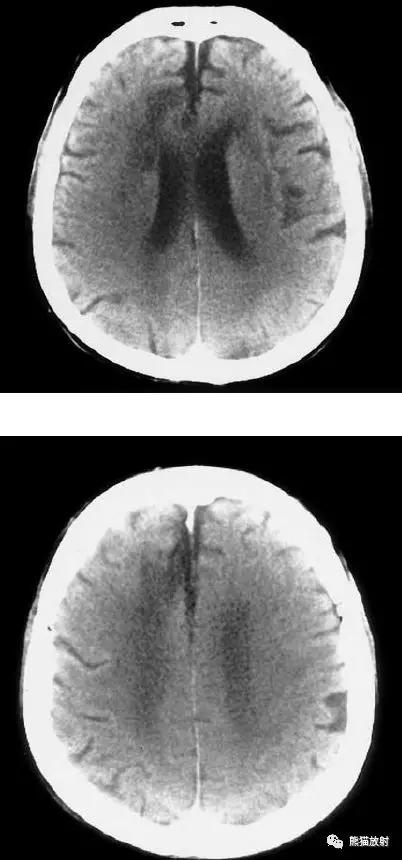 脑梗死丨演变、血供区域分布、CT表现