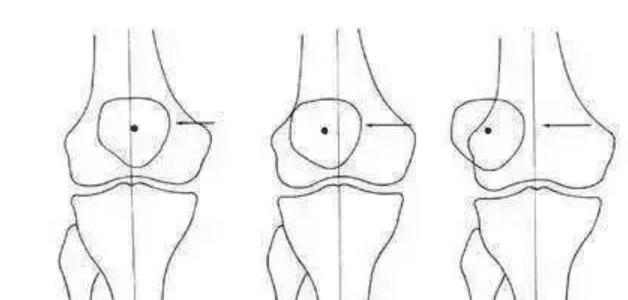 髌骨不舒服应该怎么锻炼,髌骨不肿可是疼怎么办