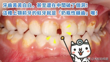 小朋友的蛀牙是怎么形成的,10岁小孩有7颗蛀牙