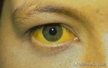 眼睛出现黄疸是什么病,浑身黄眼睛黄另外胆肿大是什么病