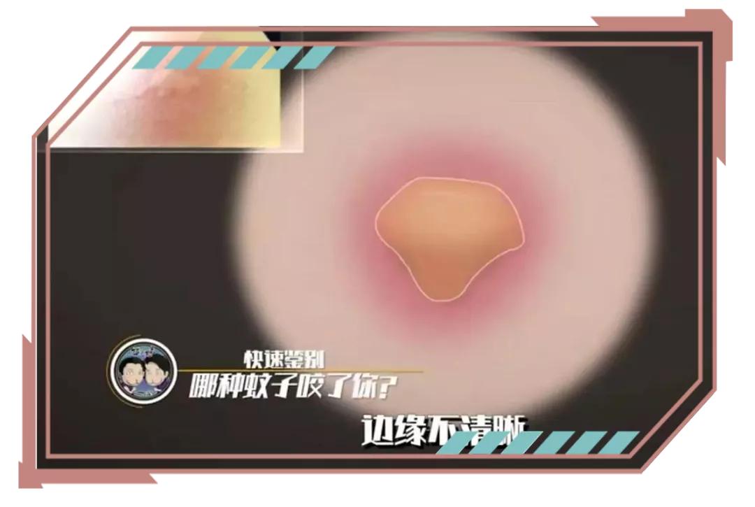 同样是被咬，为啥你的包又痒又大？