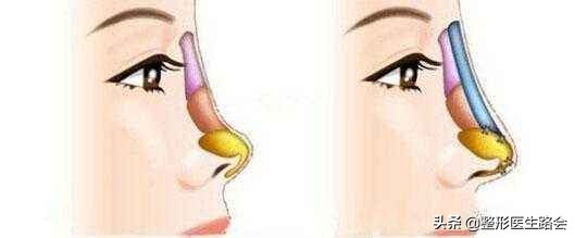 鼻子高的人正面看不是很好看,过于高挺突兀的鼻子