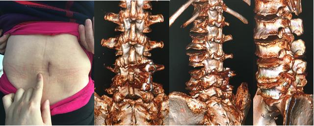 大姐腰椎间盘突出，陈明博士微创治疗，你信吗？