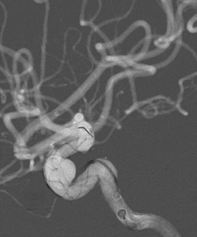 Tubridge®治疗多发性动脉瘤