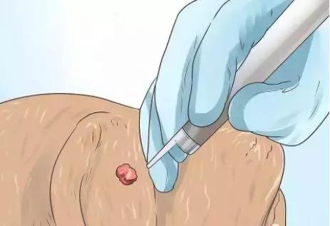 狗狗身上瘊子怎么去除,狗狗身上的斑点怎么去除