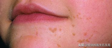 皮肤科疣状症怎么治,皮肤科医院如何治扁平疣