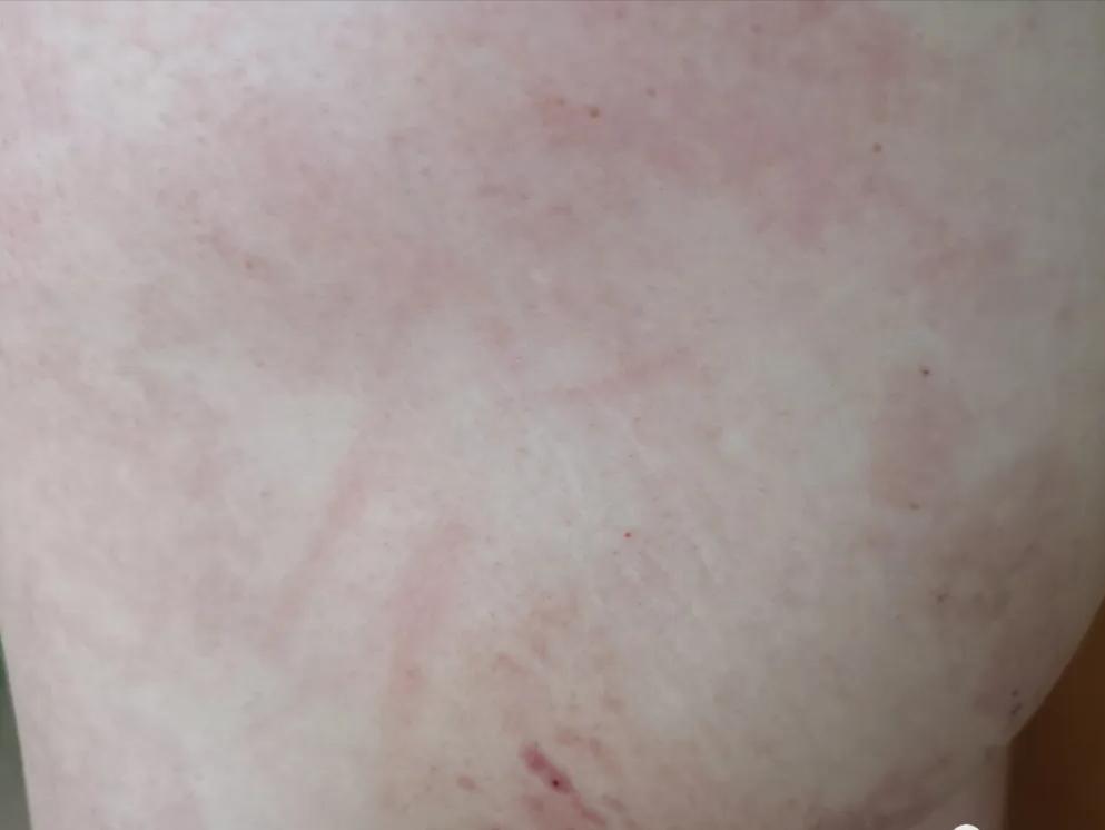 用药后身上起红疹子,用药后的红疹会自己消退吗