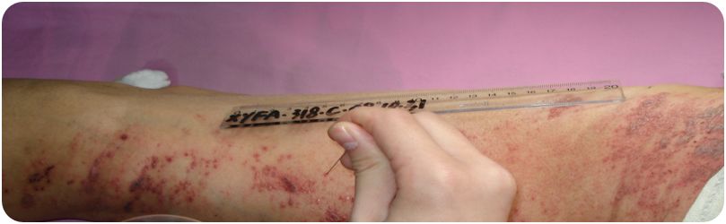 中医火针疗法教学视频,火针操作手法