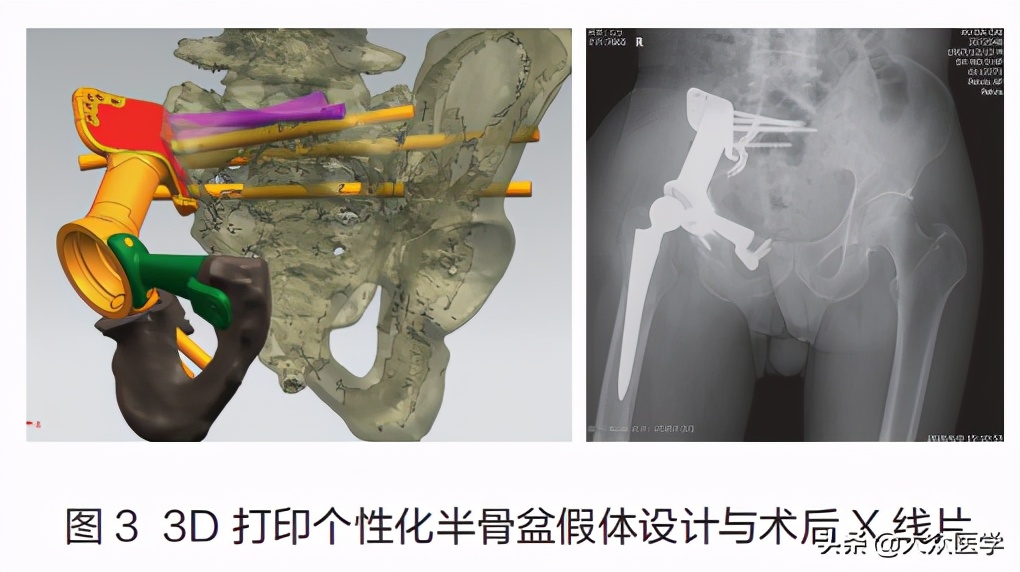 3d打印骨盆成功案例,3d打印肿瘤技术视频