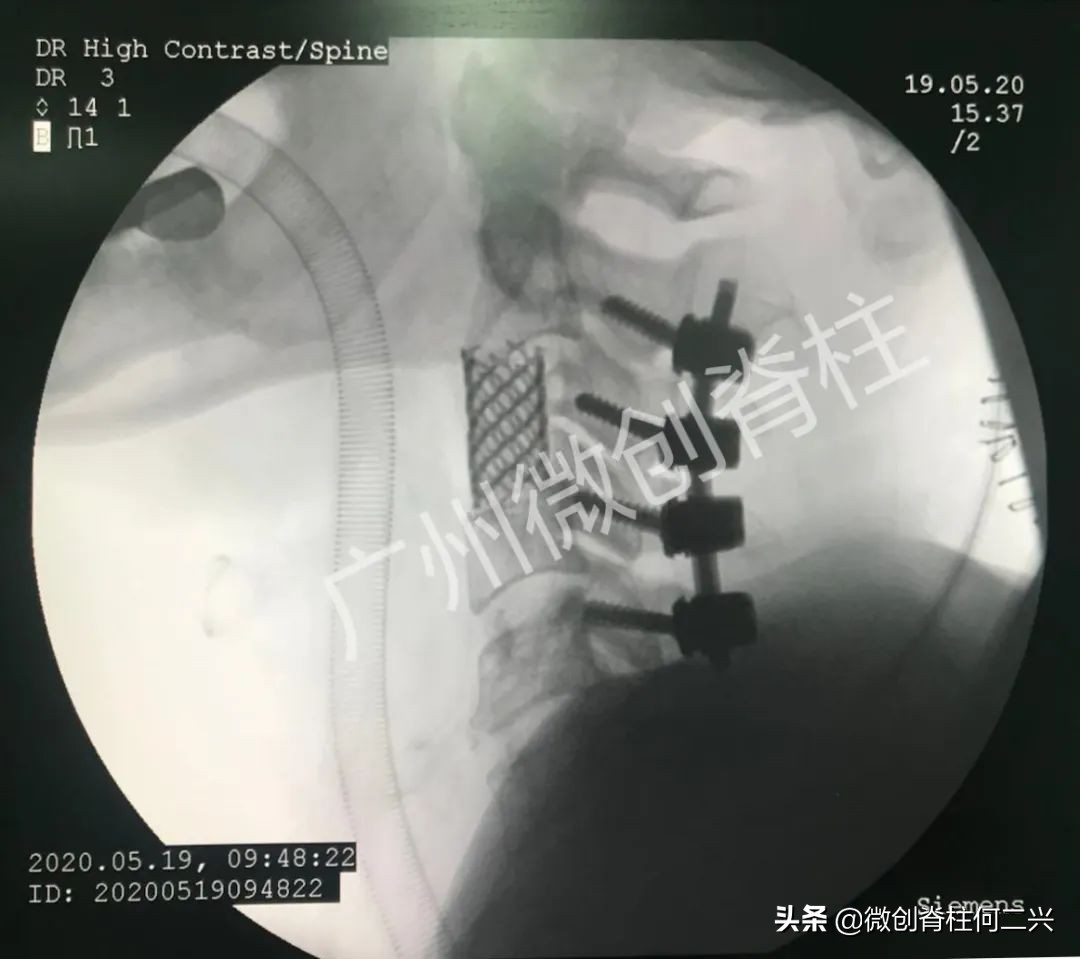 颈椎髓内肿瘤手术的权威专家,微创治疗肿瘤