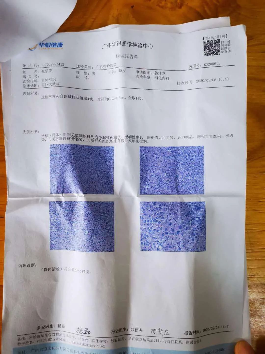 胃癌已转移到腹膜了严重吗,胃癌晚期转移到肝导致肝昏迷