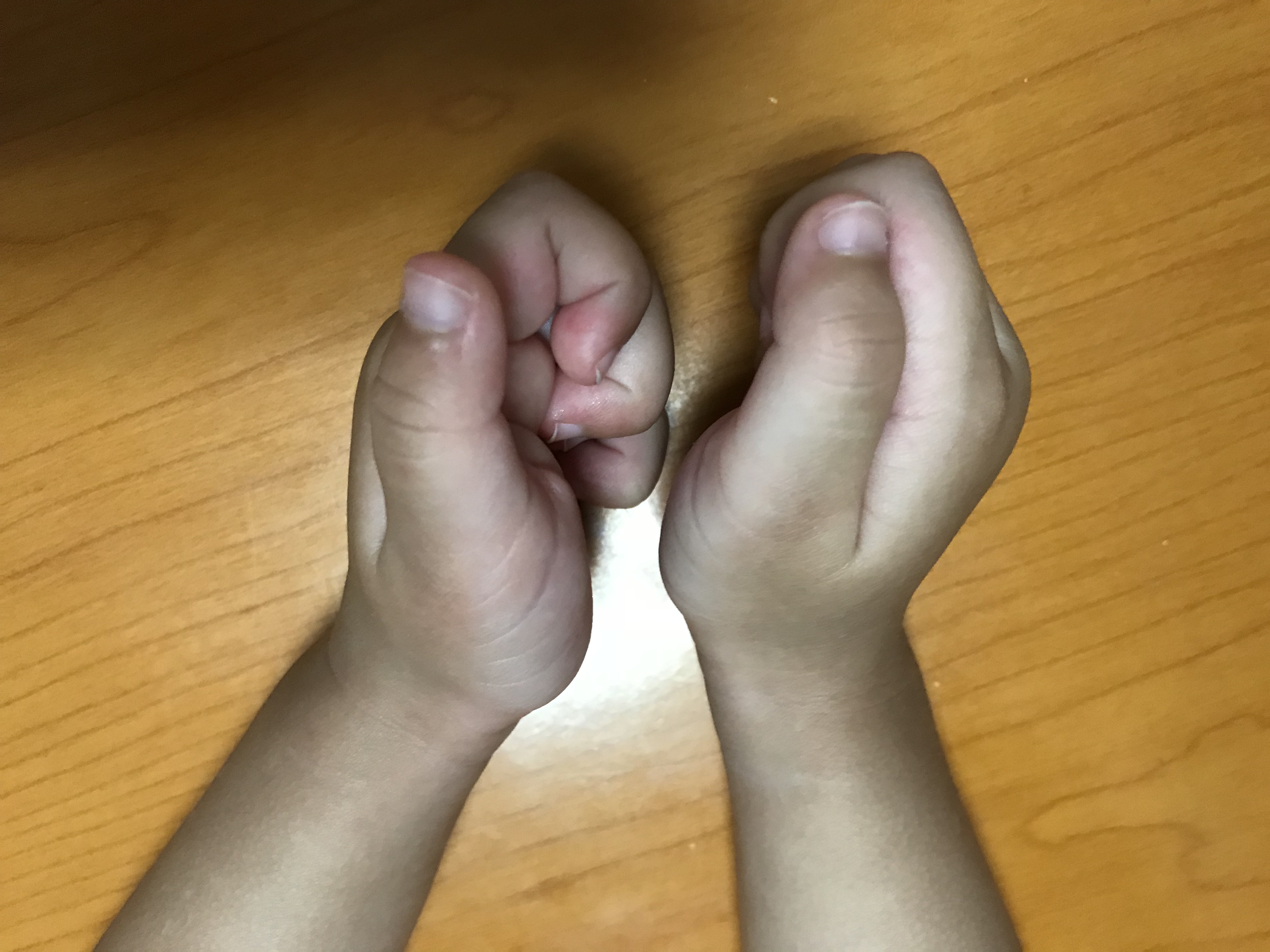 小孩大拇指伸不直的原因是什么,小孩子大拇指伸不直是什么原因