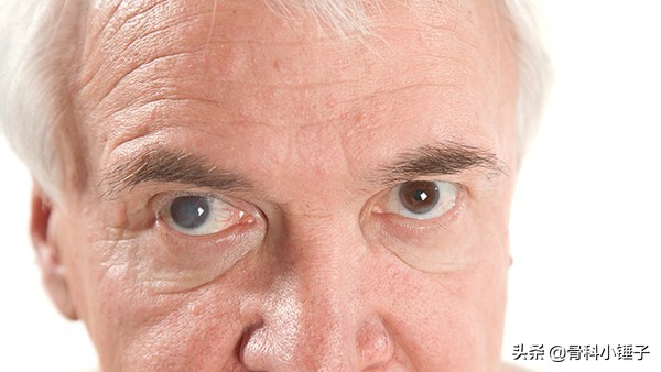 眼部带状疱疹症状表现,眼部带状疱疹是什么原因造成的