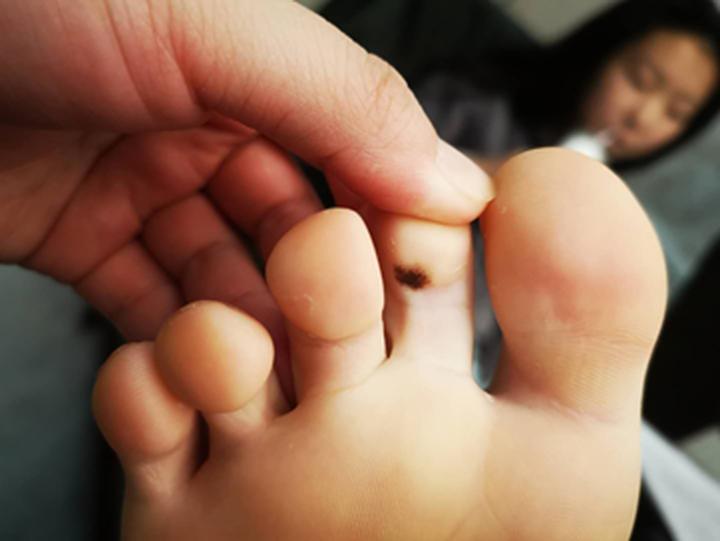 哪些部位长痣预示一生劳碌,痣的位置预示着什么