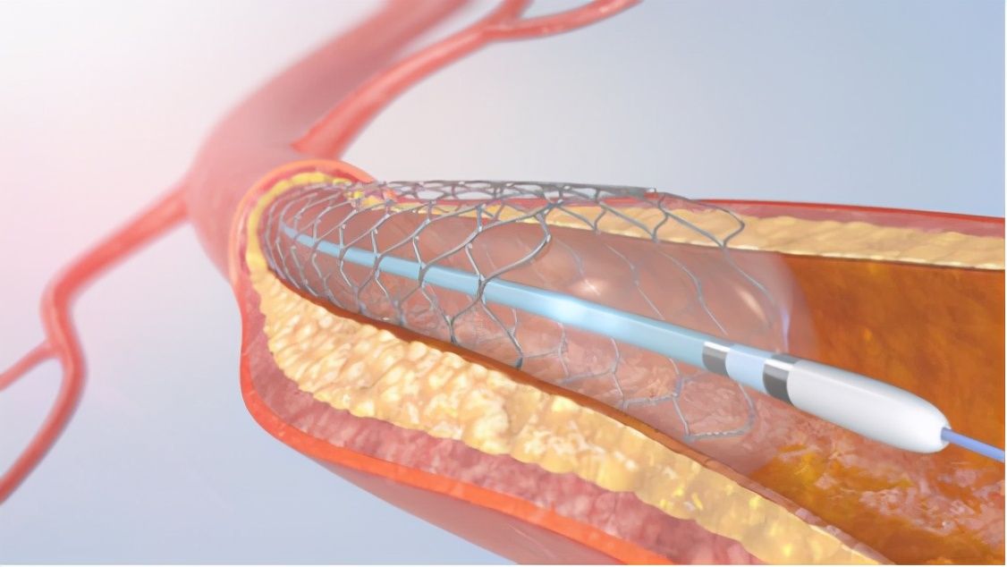 乐普心脏支架多少钱,心脏支架医保最新价格