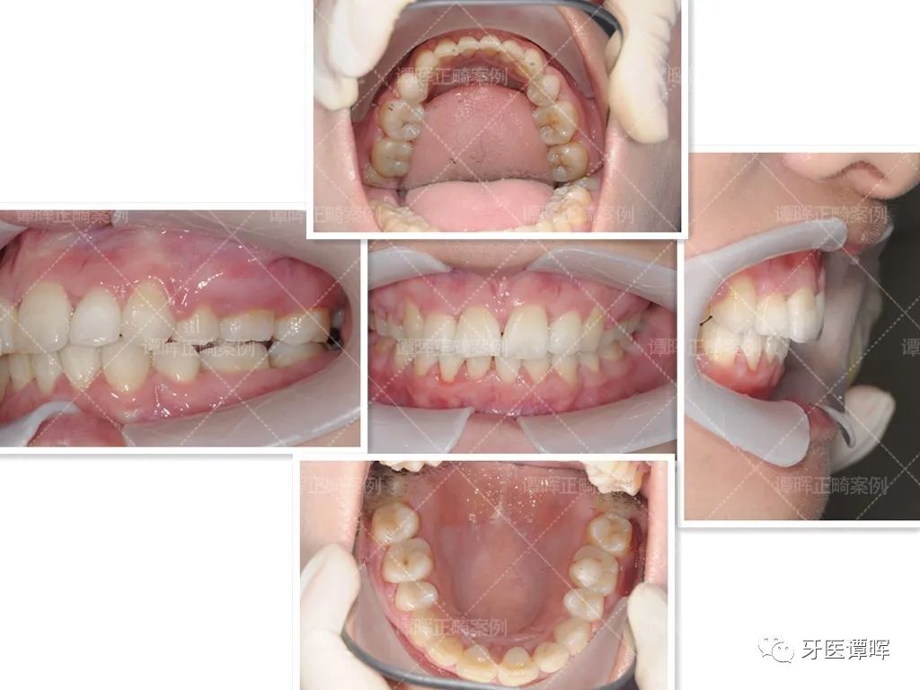 门牙前突牙齿不齐矫正案例分享,门牙和旁边牙齿不齐最快矫正方法