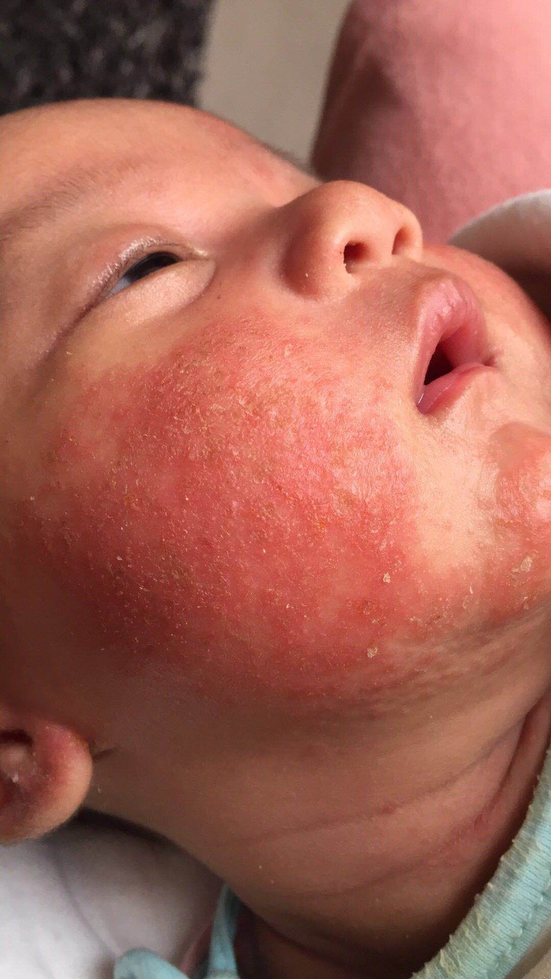 婴儿干性湿疹抹护肤品没有激素,宝宝湿疹要选抗过敏保湿护肤品