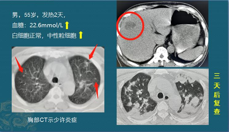 糖尿病人不要犟，有1种细菌喜欢喝糖浆，感染眼睛会失明