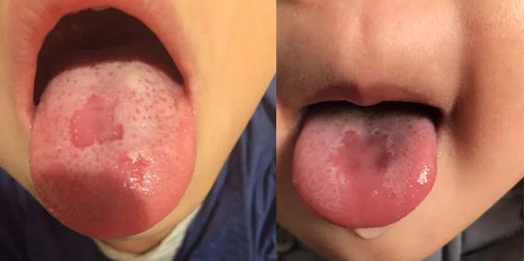 孩子舌苔脱落是怎么回事,右侧舌苔反复脱落是什么原因