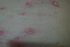 点滴型银屑病皮损为什么会变大,银屑病治疗过程中变成丘疹