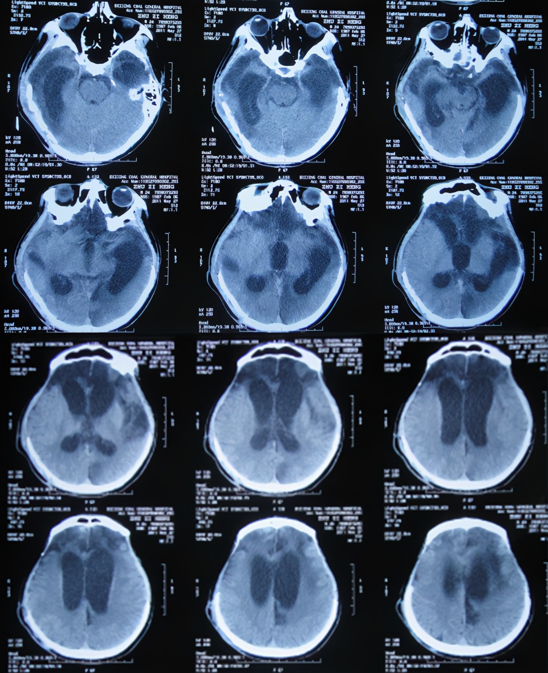 脑受伤开颅手术昏迷,开颅手术后20天发生脑积水引流