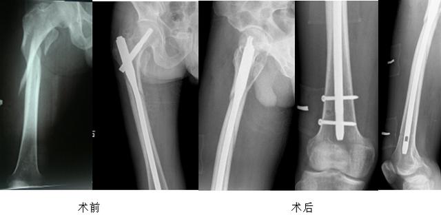 髋部骨折危害大老年人摔伤要重视,髋部骨折的最简单方法