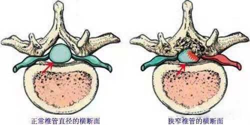 腰痛痛到走路一瘸一拐？你需要了解一下“微创减压手术”